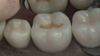 Class I Composite Preparation amp Restoration  Operative Dentistry [upl. by Airebma]