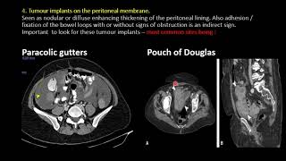 Imaging in Peritoneal Carcinomatosis [upl. by Dumond]