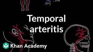 Temporal arteritis  Circulatory System and Disease  NCLEXRN  Khan Academy [upl. by Tomkiel]