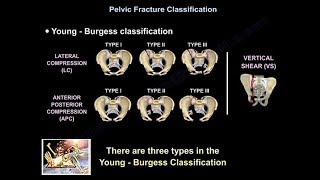 Pelvic Fractures  Everything You Need To Know  Dr Nabil Ebraheim [upl. by Ellerahs53]