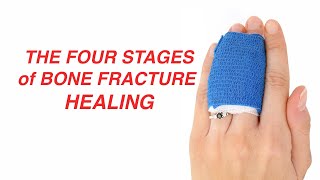 The Four Stages of Bone Fracture Healing [upl. by Dloniger]