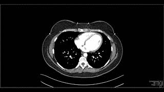 Abdominal Anatomy on Computed Tomography [upl. by Ayanad727]